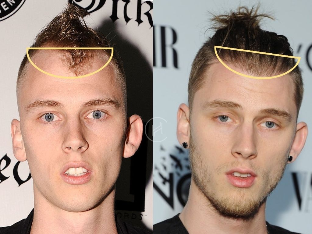 MGK Hair Transplant Journey: A Look at the Process and Potential Risks